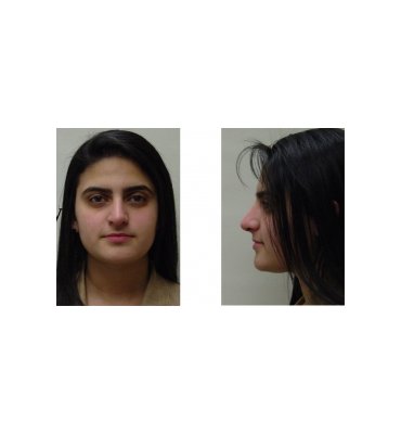 Hanging Tip Rhinoplasty After